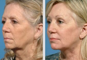 преди и след плазмено подмладяване на кожата
