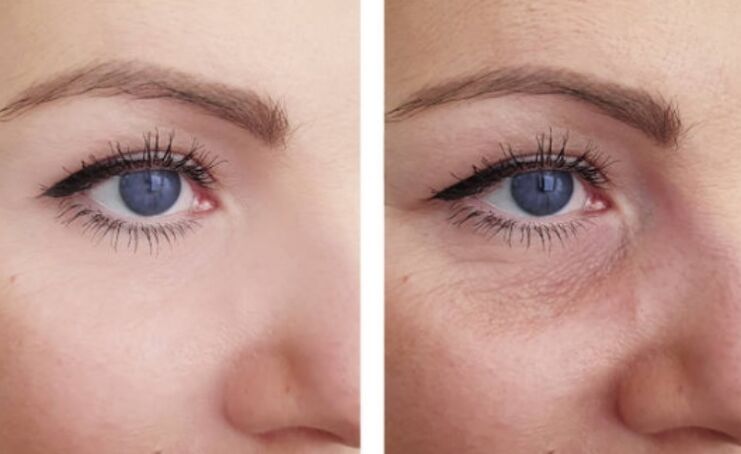 преди и след плазмено подмладяване около очите