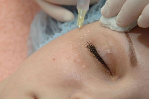 Мезотерапия - инжекционен метод за подмладяване на кожата на лицето