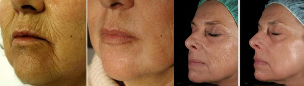 Кожата на лицето преди и след лазерно подмладяване