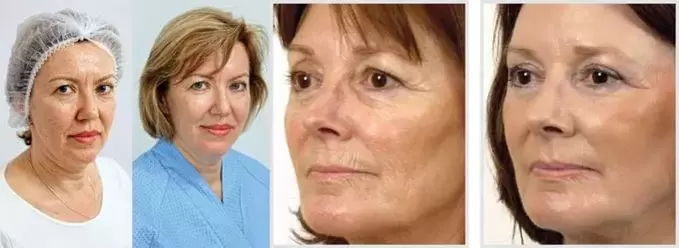 Резултатът от подмладяването на кожата на лицето с лазер е намаляването на бръчките