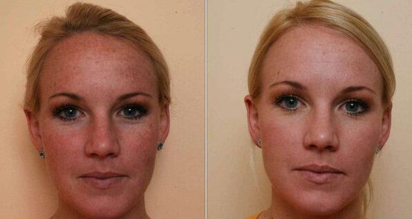 преди и след лазерно подмладяване на кожата на лицето