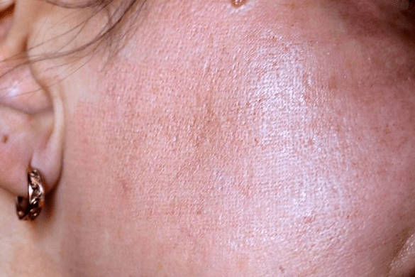 зачервяване на кожата след лазерно подмладяване