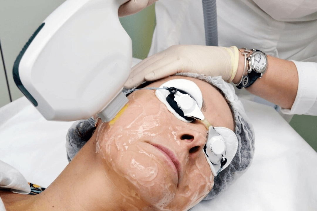 лазерно подмладяване за кожата на лицето