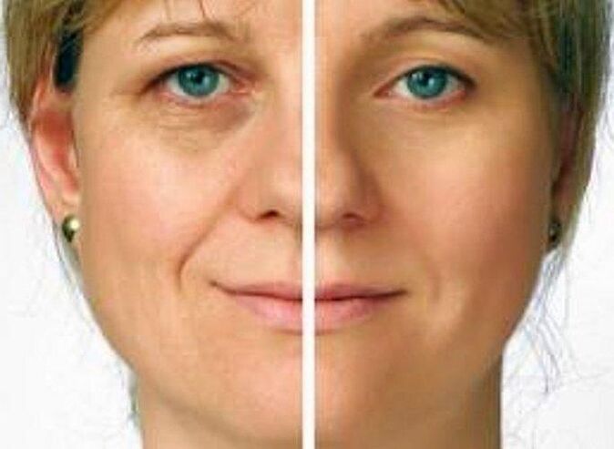 кожа около очите преди и след подмладяване