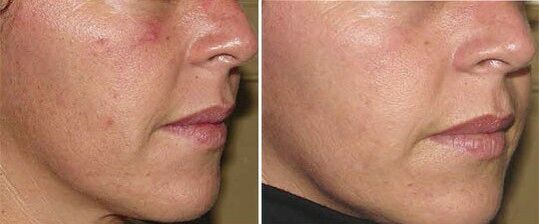 лице преди и след хардуерно подмладяване на кожата